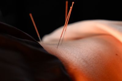 Dry needling treatment